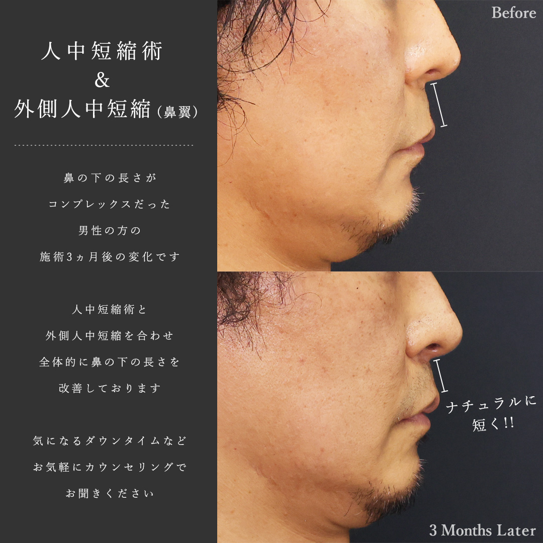 人中短縮術(リップリフト)・外側人中短縮術の症例写真 施術前後 