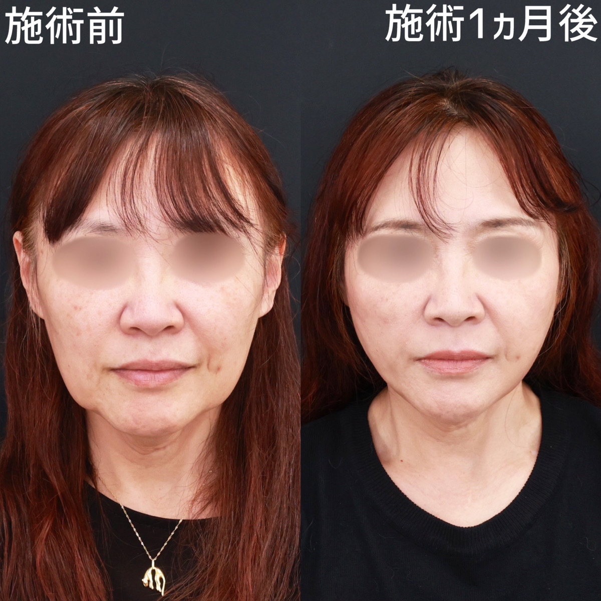 【糸リフト極×ジョールファット除去】たるみ改善！小顔整形なら1ヵ月でここまで若返る◎