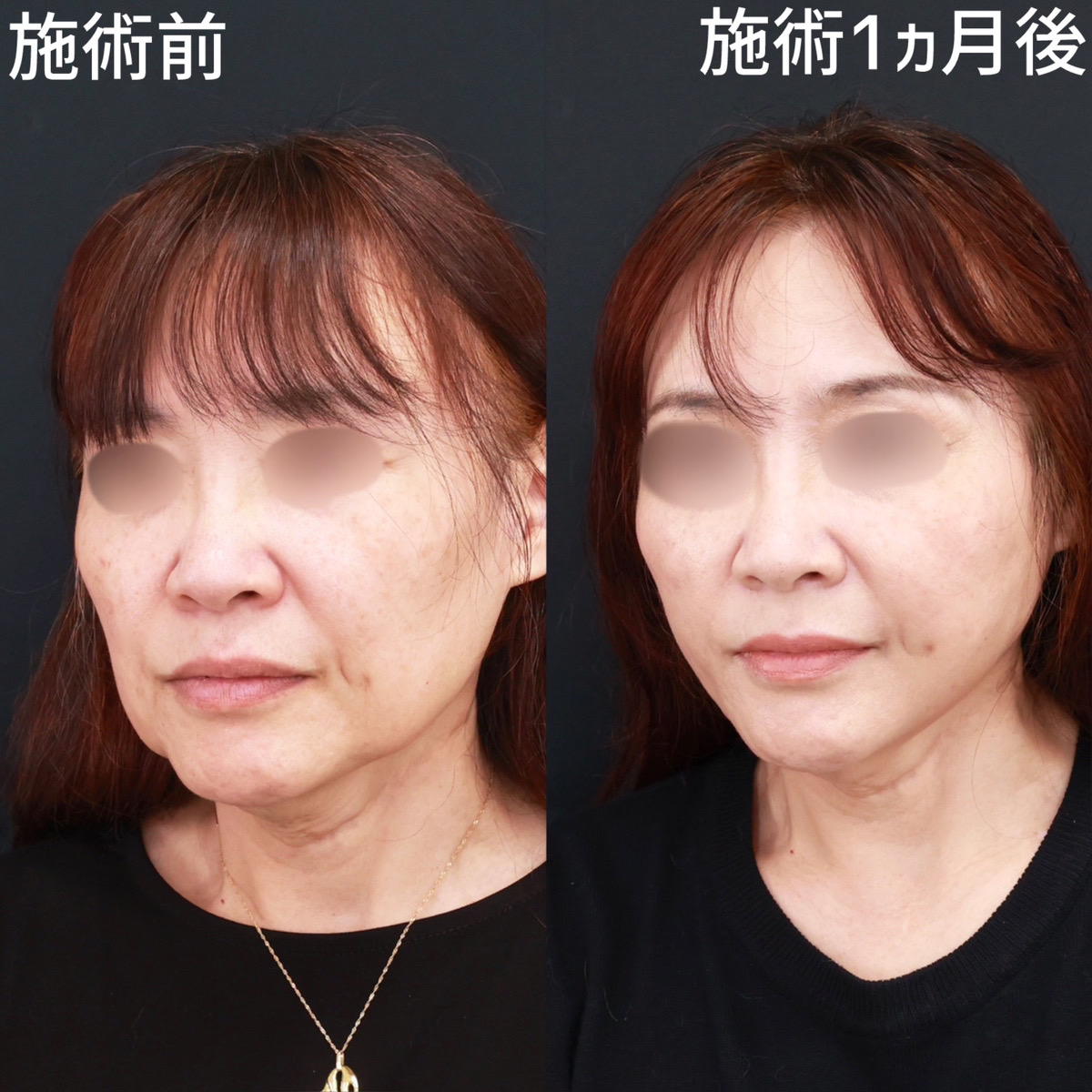 TAC式 ツヤ肌コラーゲンリフト®/ジョールファット除去の症例写真 施術前後 