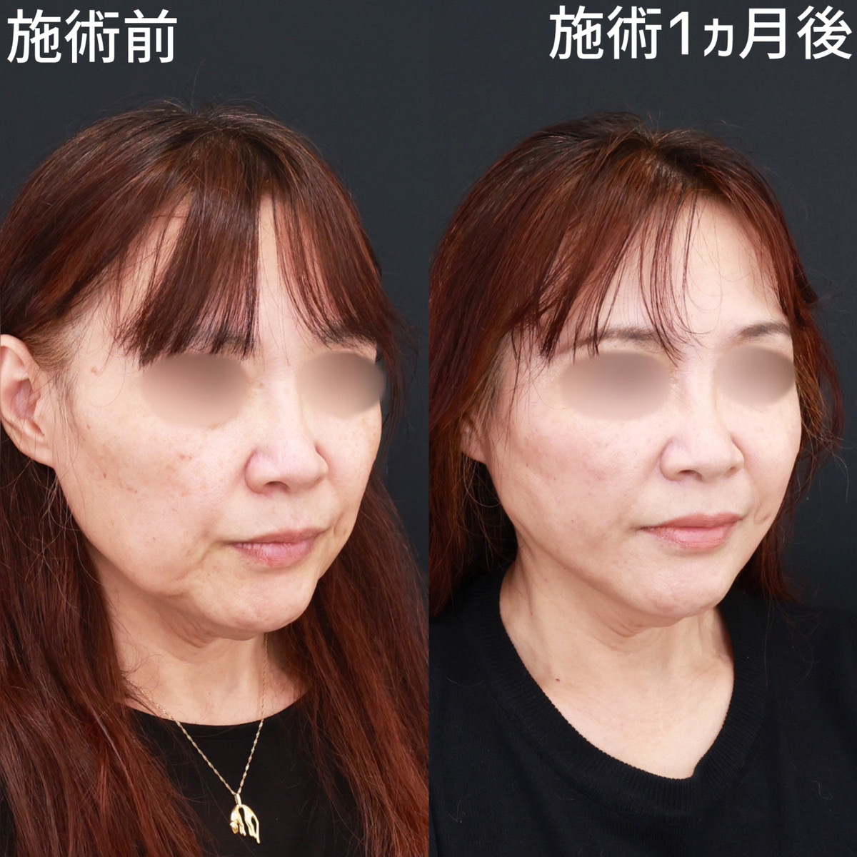 TAC式 ツヤ肌コラーゲンリフト®/ジョールファット除去の症例写真 施術前後 