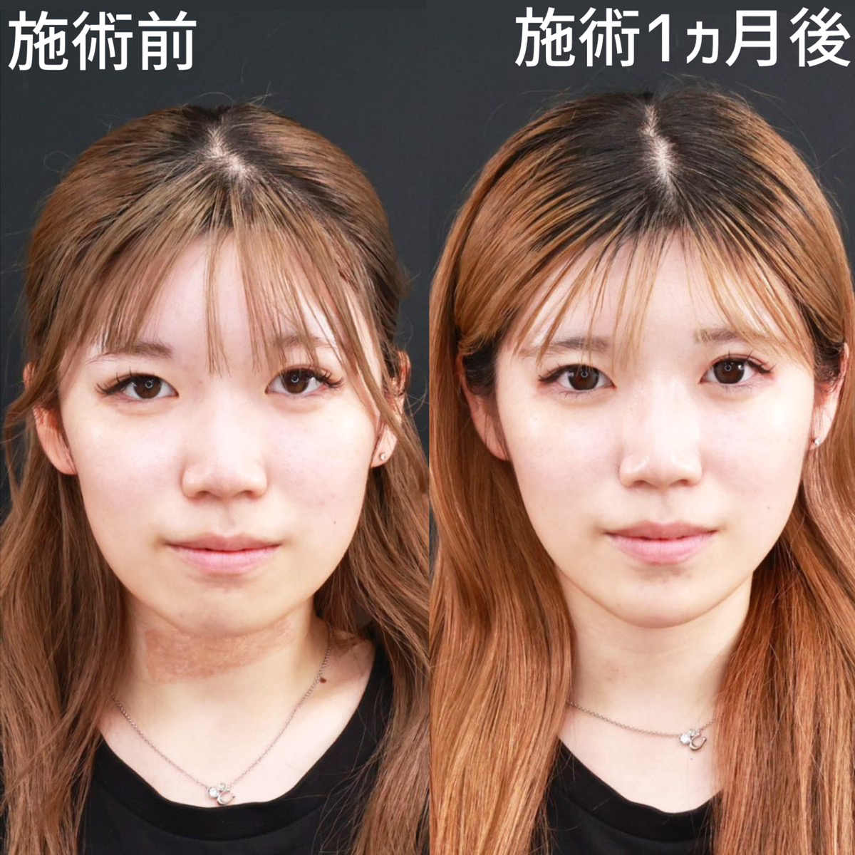 【糸リフト極】お顔の余白を減らしてスッキリ小顔に◎