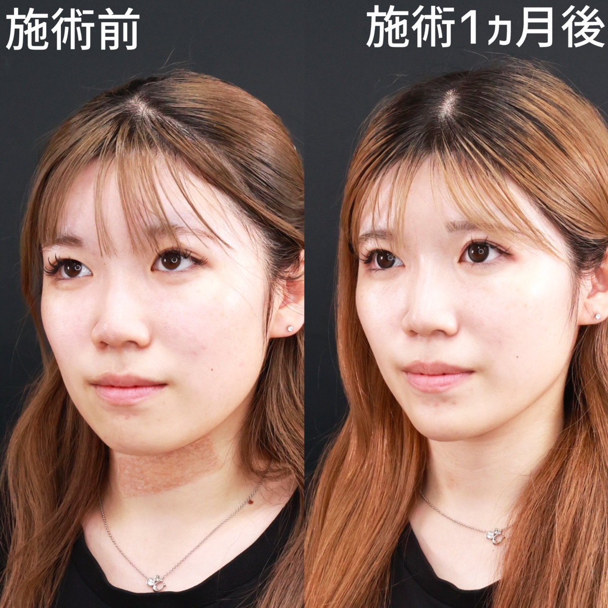 TAC式 ツヤ肌コラーゲンリフト®/顎のヒアルロン酸注射/ボトックス注射：その他の症例写真 施術前後 