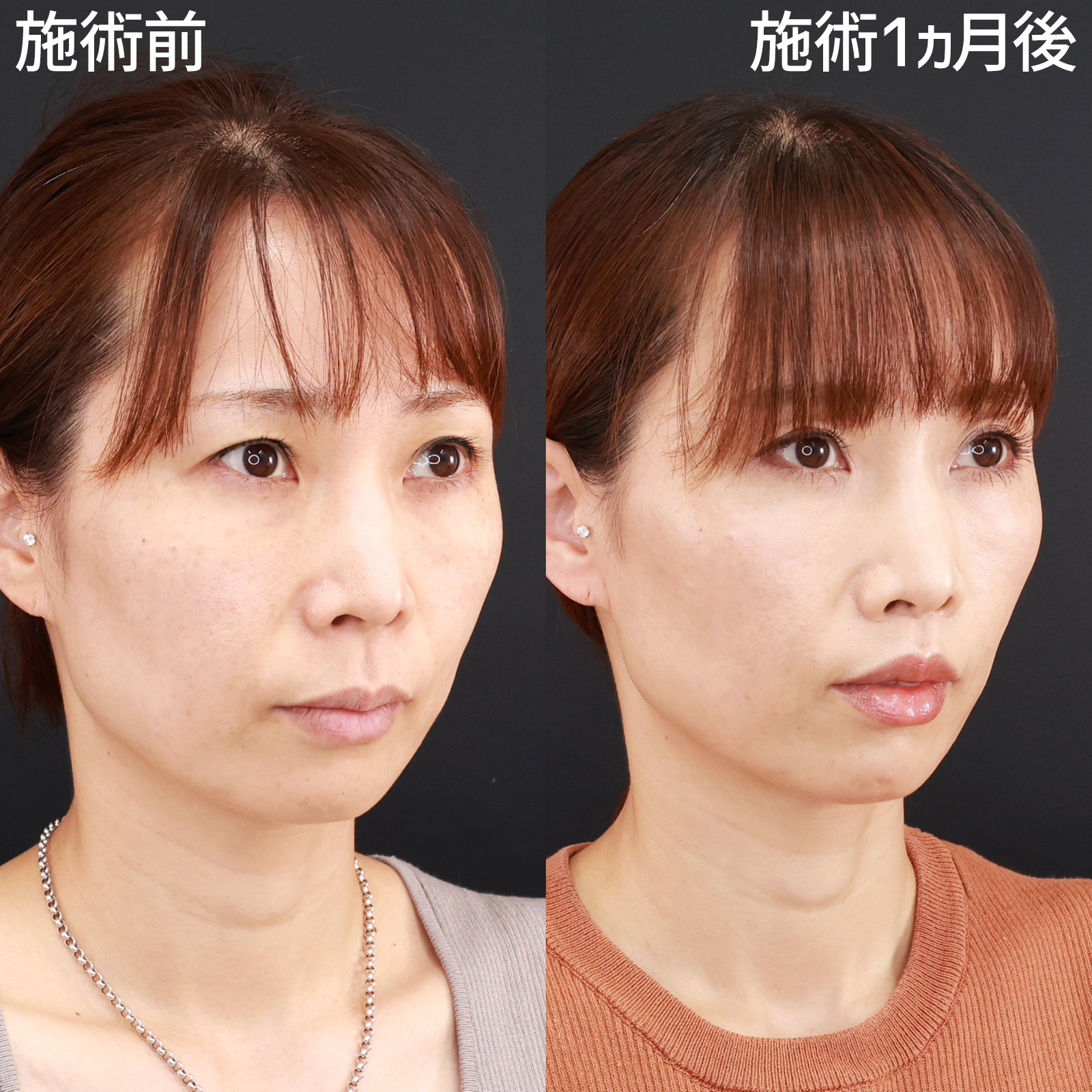 人中短縮術(リップリフト)・外側人中短縮術/TAC式 鼻翼縮小術（小鼻縮小）の症例写真 施術前後 