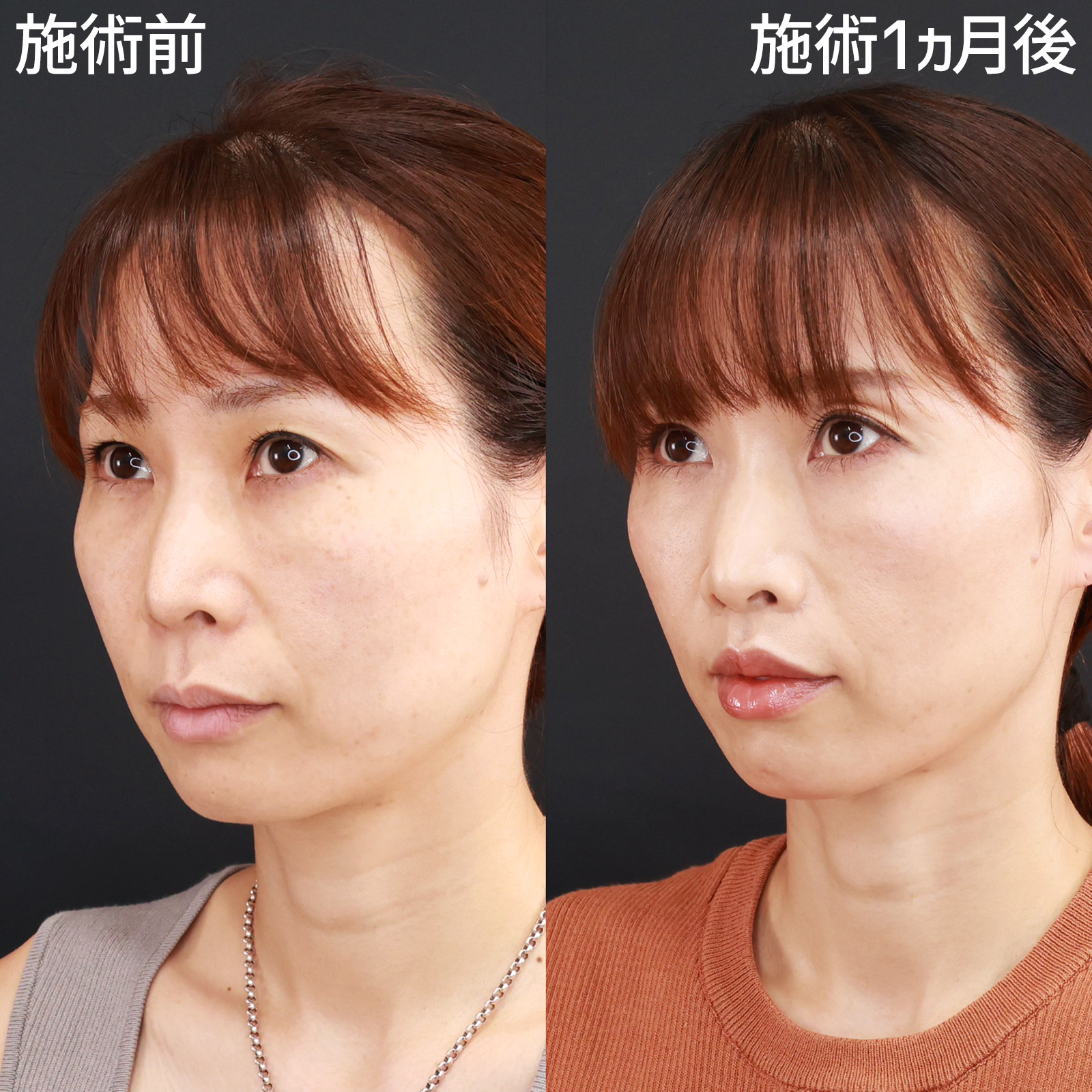 人中短縮術(リップリフト)・外側人中短縮術/TAC式 鼻翼縮小術（小鼻縮小）の症例写真 施術前後 