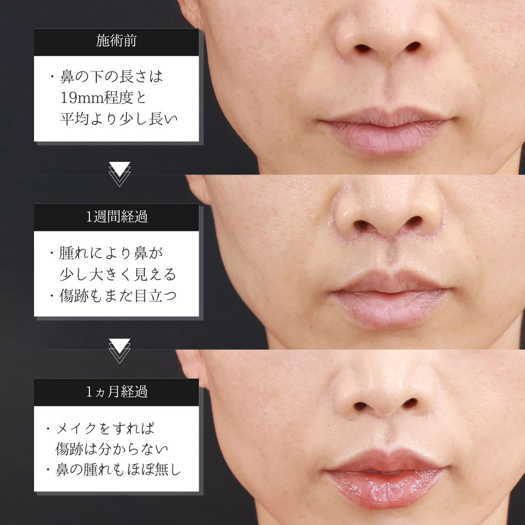 人中短縮術(リップリフト)・外側人中短縮術/TAC式 鼻翼縮小術（小鼻縮小）の症例写真 施術前後 