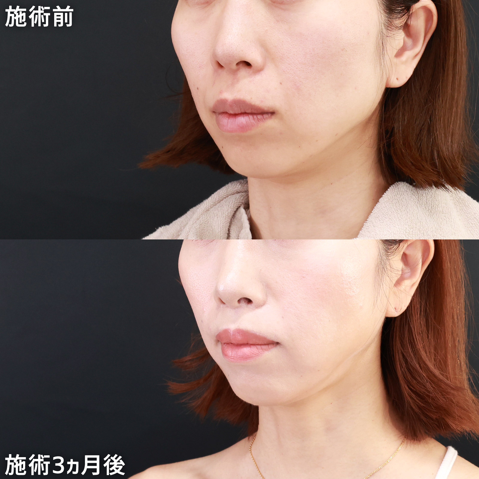 人中短縮術(リップリフト)・外側人中短縮術/TAC式 鼻翼縮小術(小鼻縮小)の症例写真 施術前後