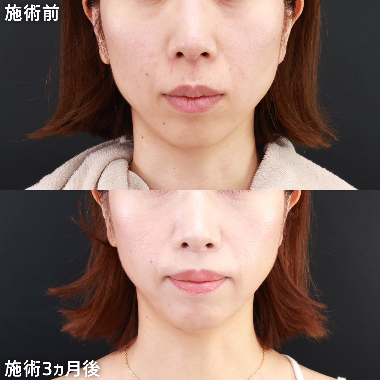 【人中短縮術＆外側人中短縮術】下顔面をキュッと引き締め、間延びした印象を改善！