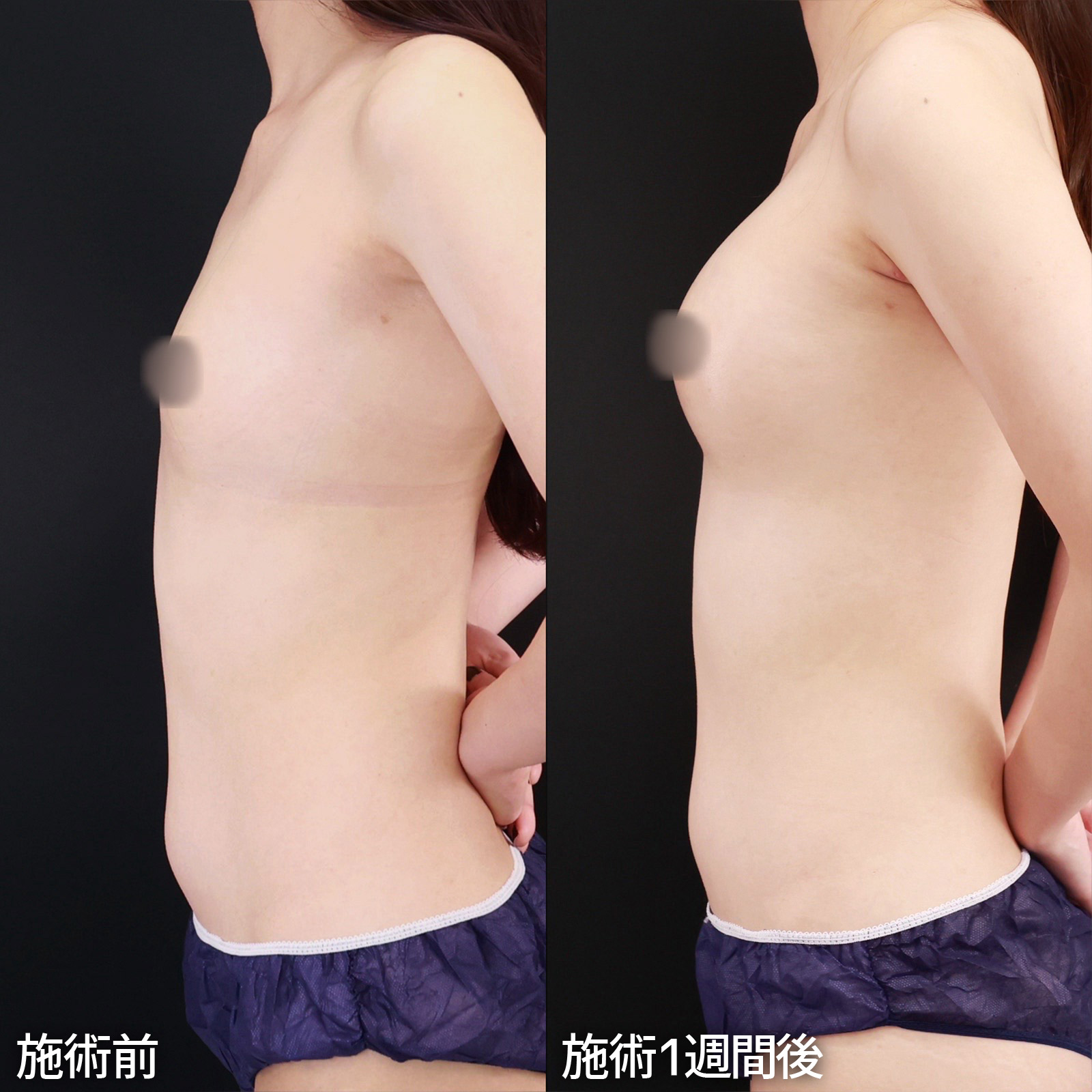脂肪注入豊胸（コンデンスリッチ・ピュアグラフト・１day脂肪豊胸）の症例写真 施術前後 