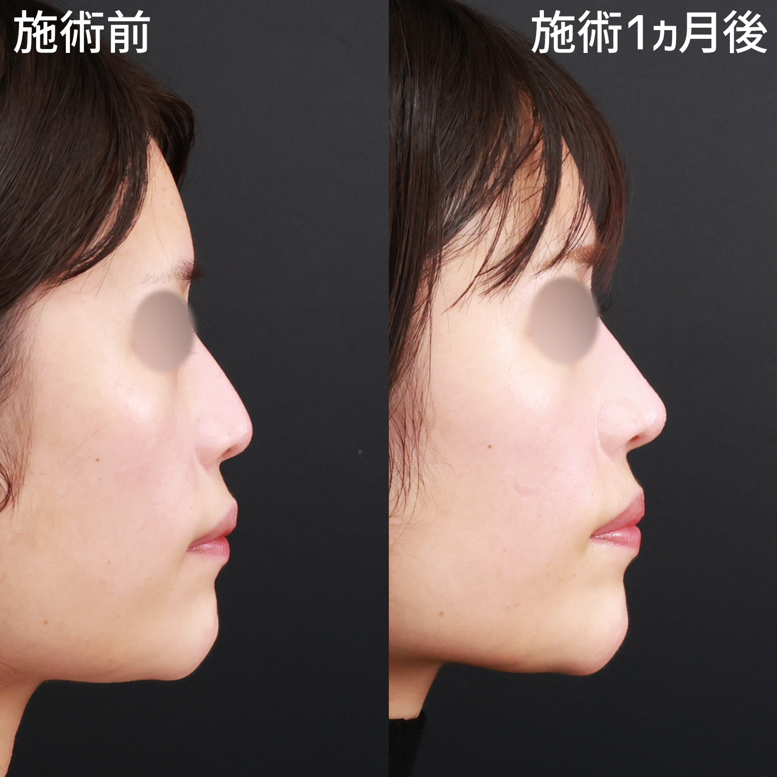 【鼻尖4Dノーズ】切らないのでバレにくい！ナチュラルに鼻先を高く