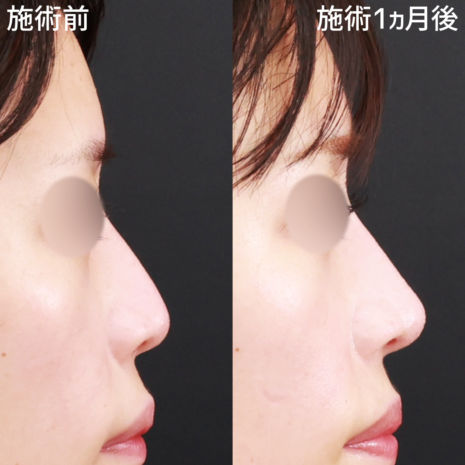 鼻尖4Dノーズ/鼻尖形成・鼻尖縮小の症例写真 施術前後 