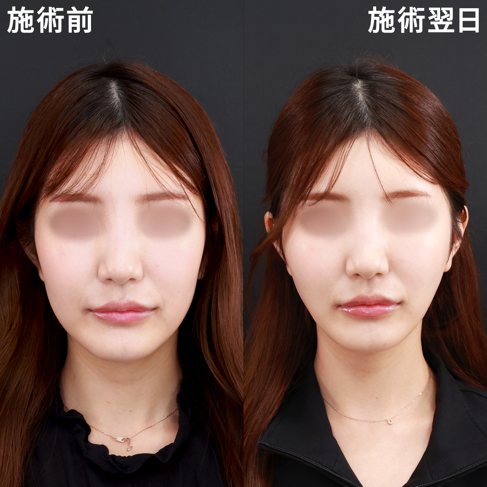 【糸リフト極】たるみを解消！面長顔を卵型にかえてスッキリ若々しく