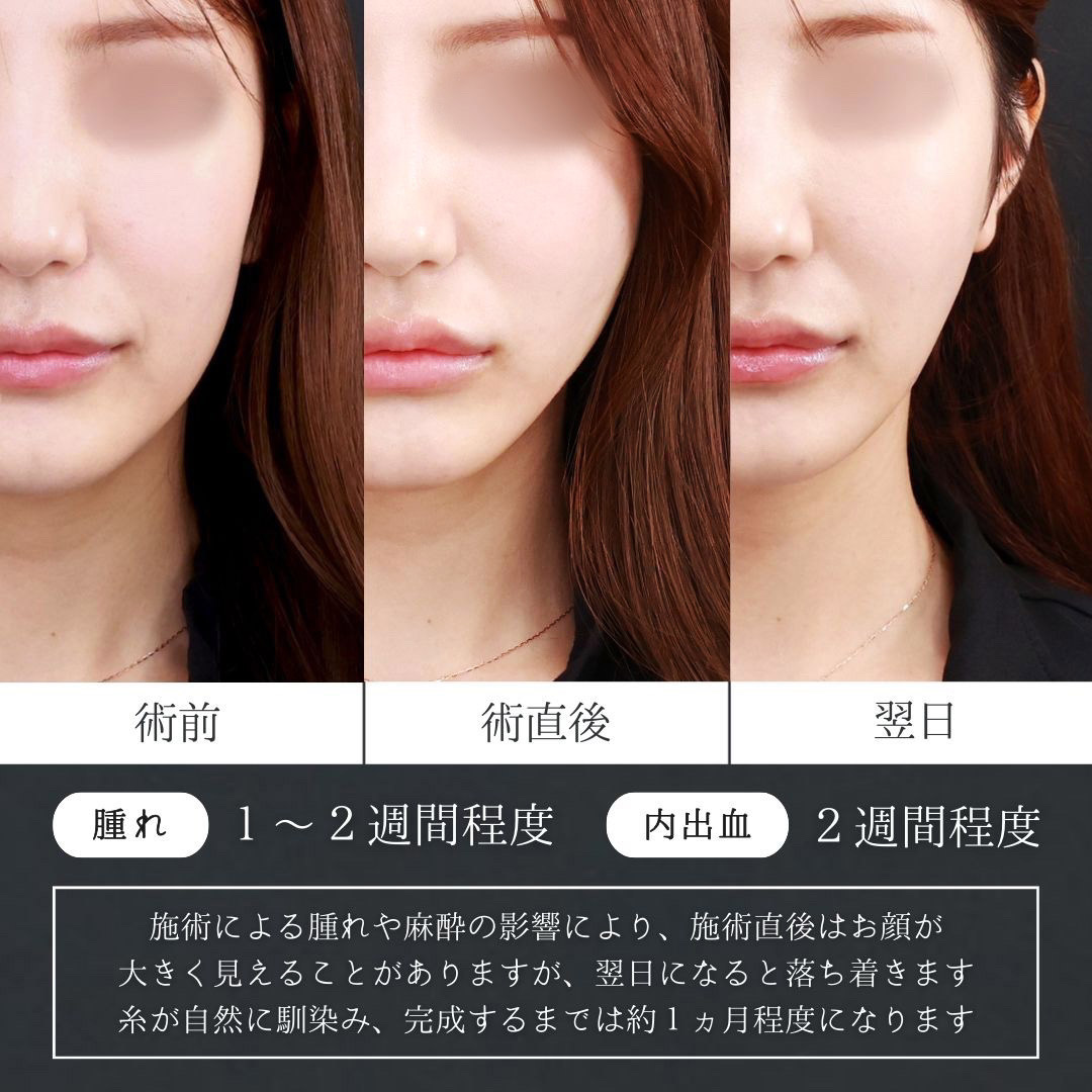 TAC式 ツヤ肌コラーゲンリフト®/エラボトックス注射/ボトックス注射：その他の症例写真 施術前後 