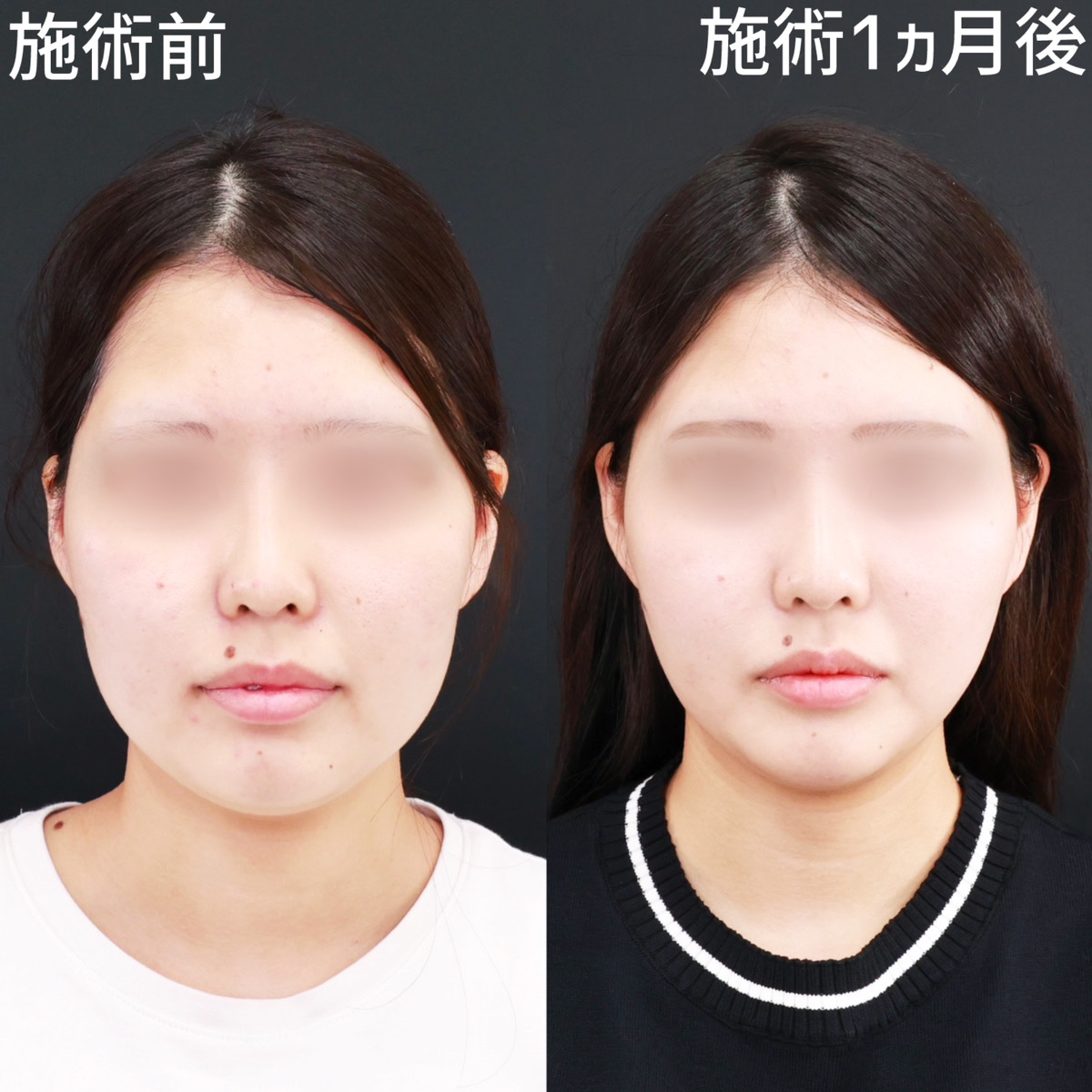 【糸リフト極】小顔整形でお顔を一回り小さく！