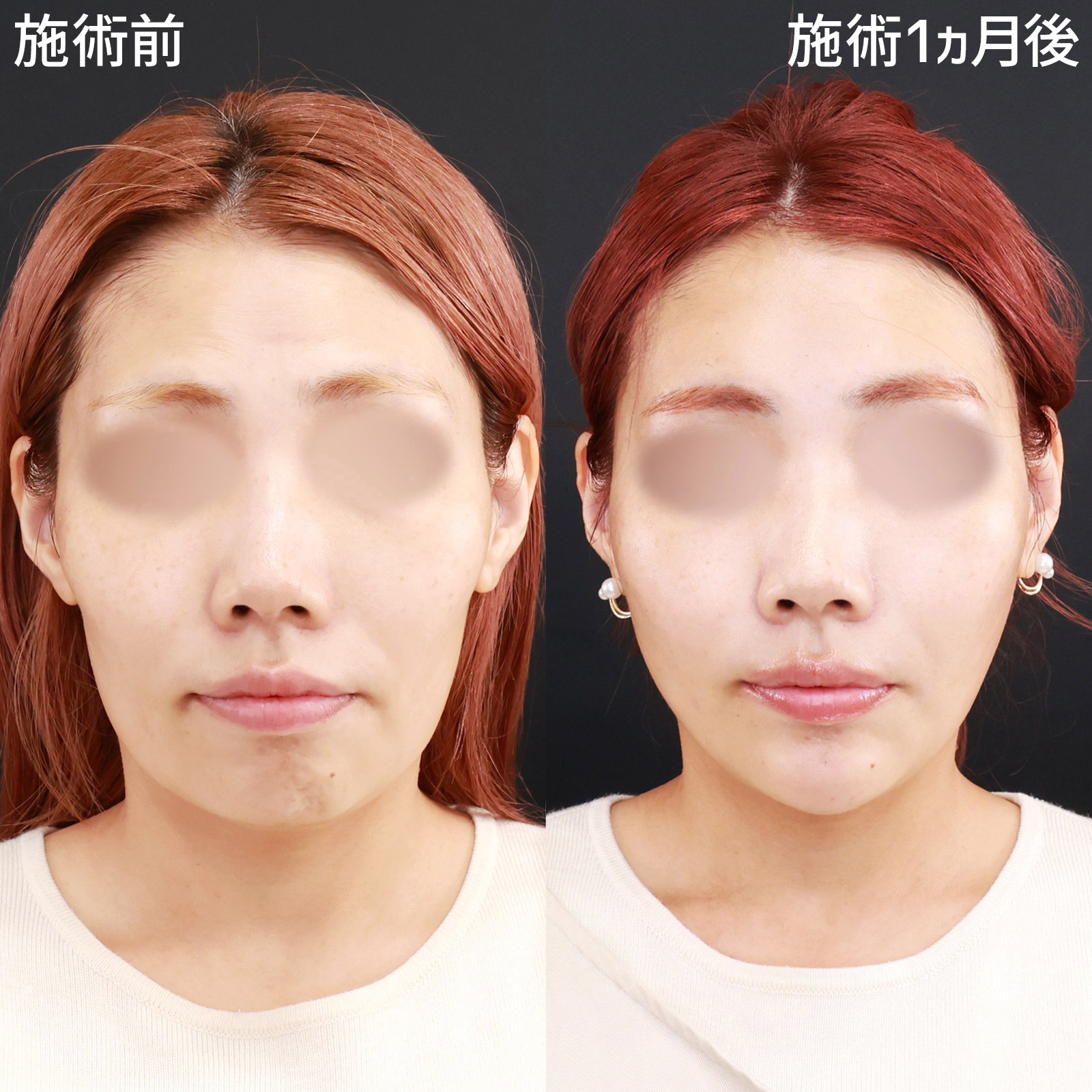 【糸リフト＆脂肪注入】見た目年齢マイナス5歳！ナチュラルな若返りを叶える