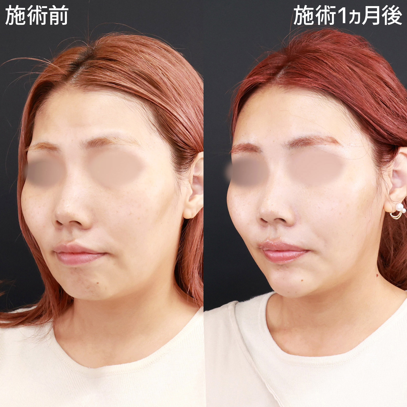 TAC式 ツヤ肌コラーゲンリフト®/顔の脂肪注入(コンデンスリッチフェイス)/おでこボトックス注射の症例写真 施術前後 