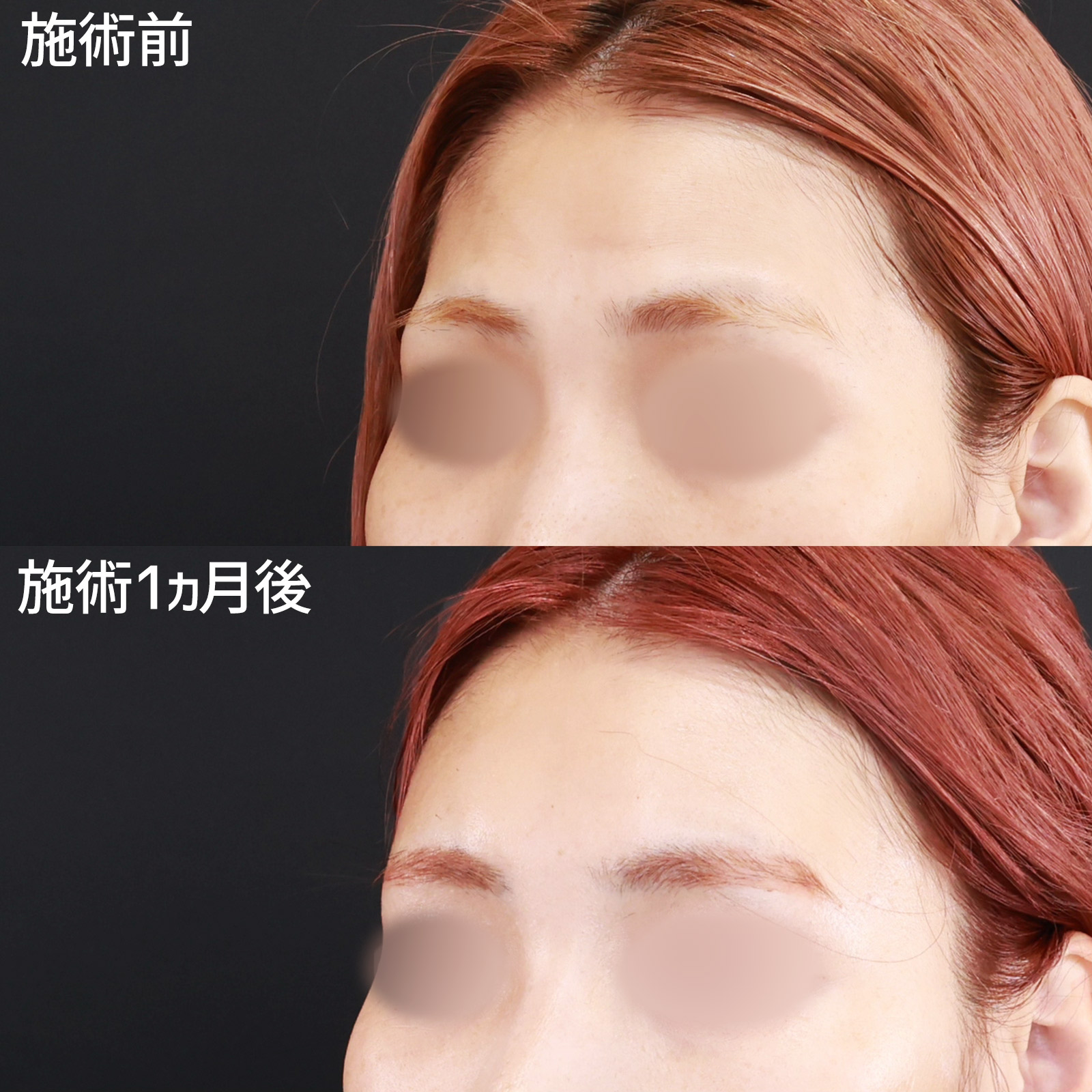 TAC式 ツヤ肌コラーゲンリフト®/顔の脂肪注入(コンデンスリッチフェイス)/おでこボトックス注射の症例写真 施術前後 