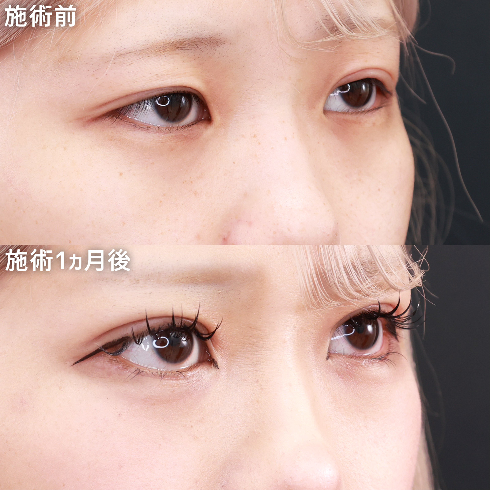 二重埋没法/グラマラスライン（タレ目形成）の症例写真 施術前後 