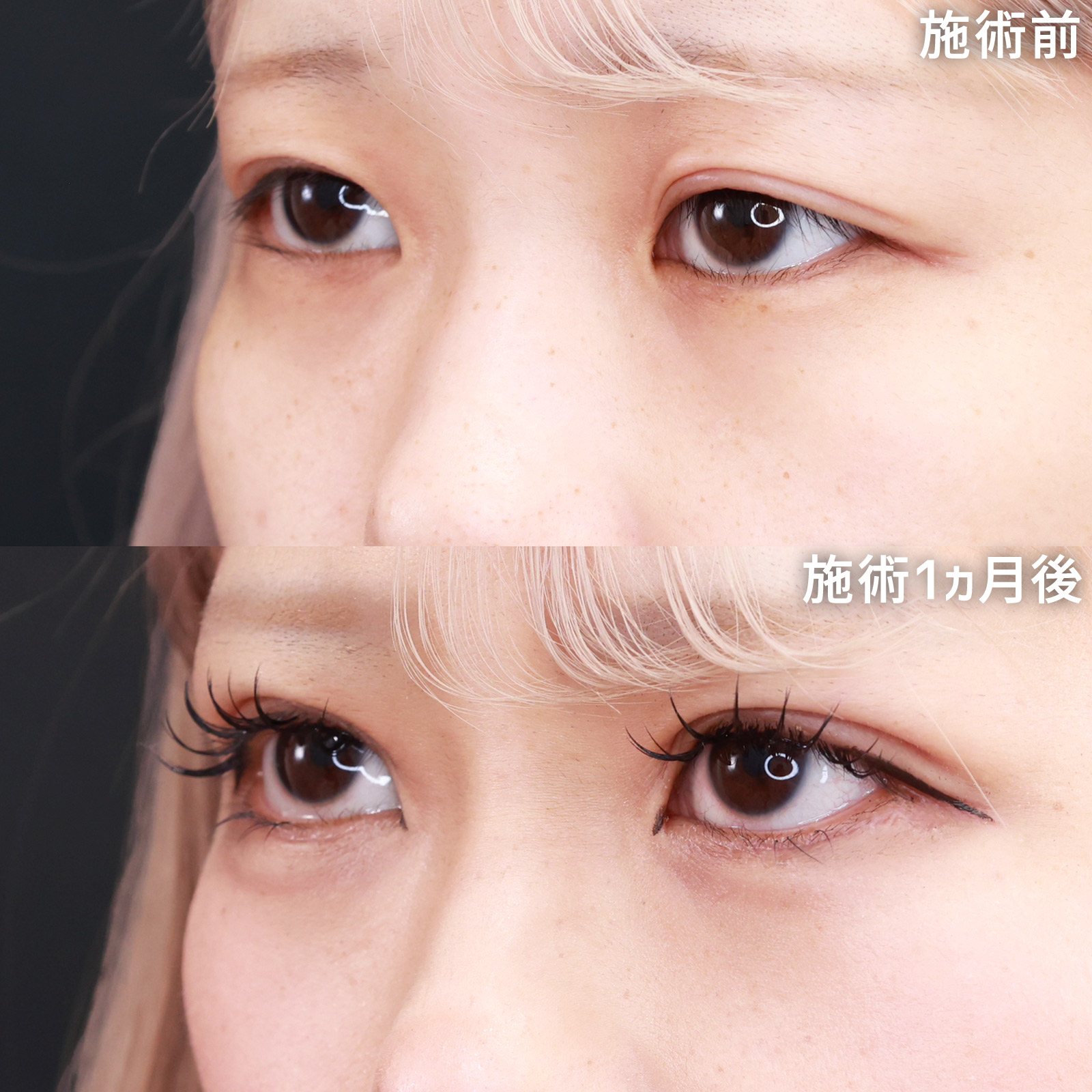 二重埋没法/グラマラスライン（タレ目形成）の症例写真 施術前後 