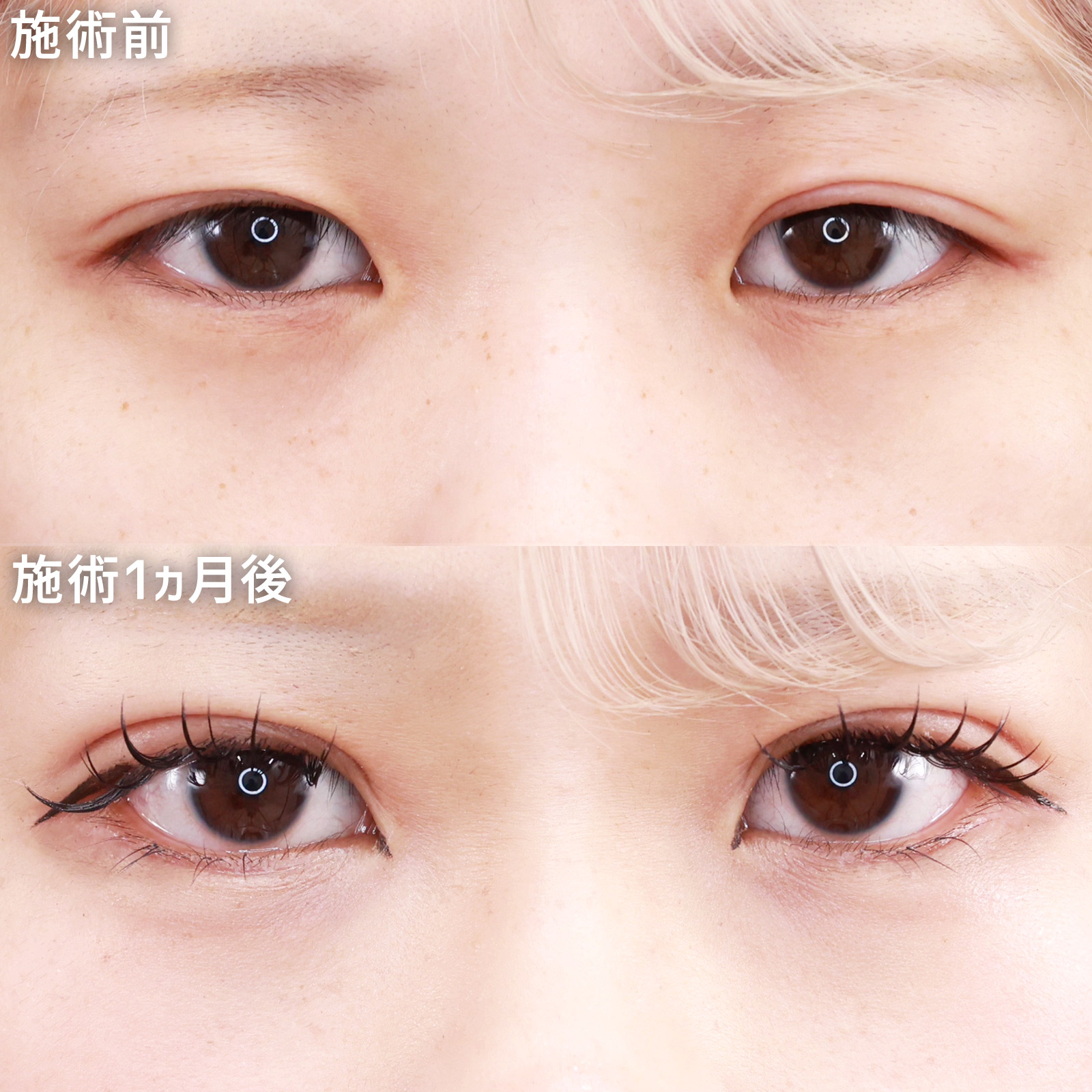 二重埋没法/グラマラスライン（タレ目形成）の症例写真 施術前後 