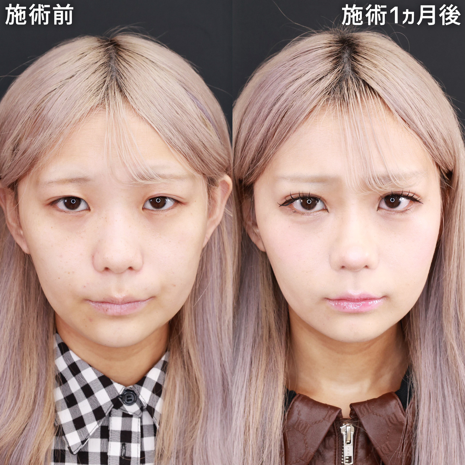 【タレ目形成＆二重埋没法】目の縦幅を出し、存在感のある可愛いデカ目に！