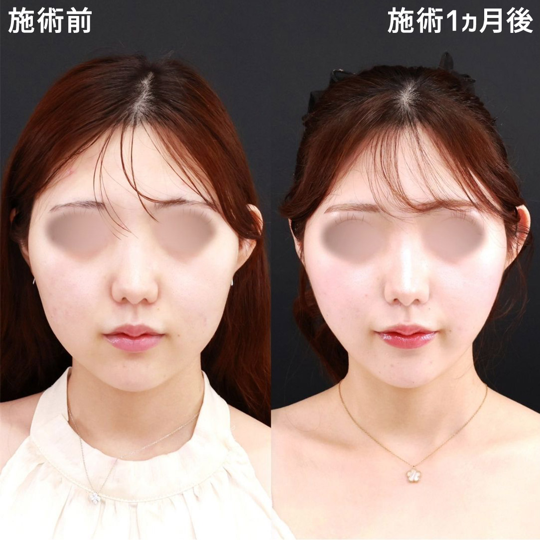 口角リフト 痛み 大阪の症例写真・画像・ビフォーアフター｜美容