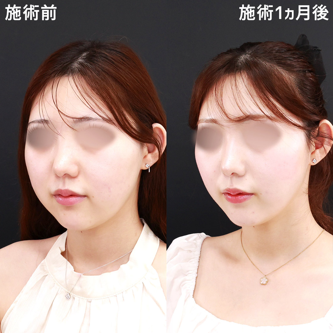 TAC式 ツヤ肌コラーゲンリフト®/ジョールファット除去の症例写真 施術前後