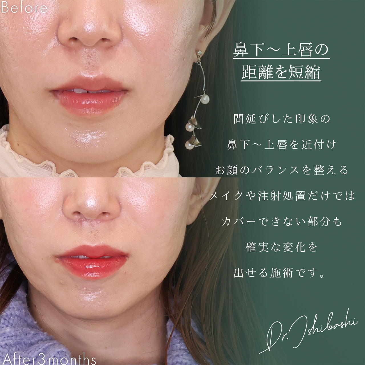 人中短縮術(リップリフト)・外側人中短縮術の症例写真 施術前後 