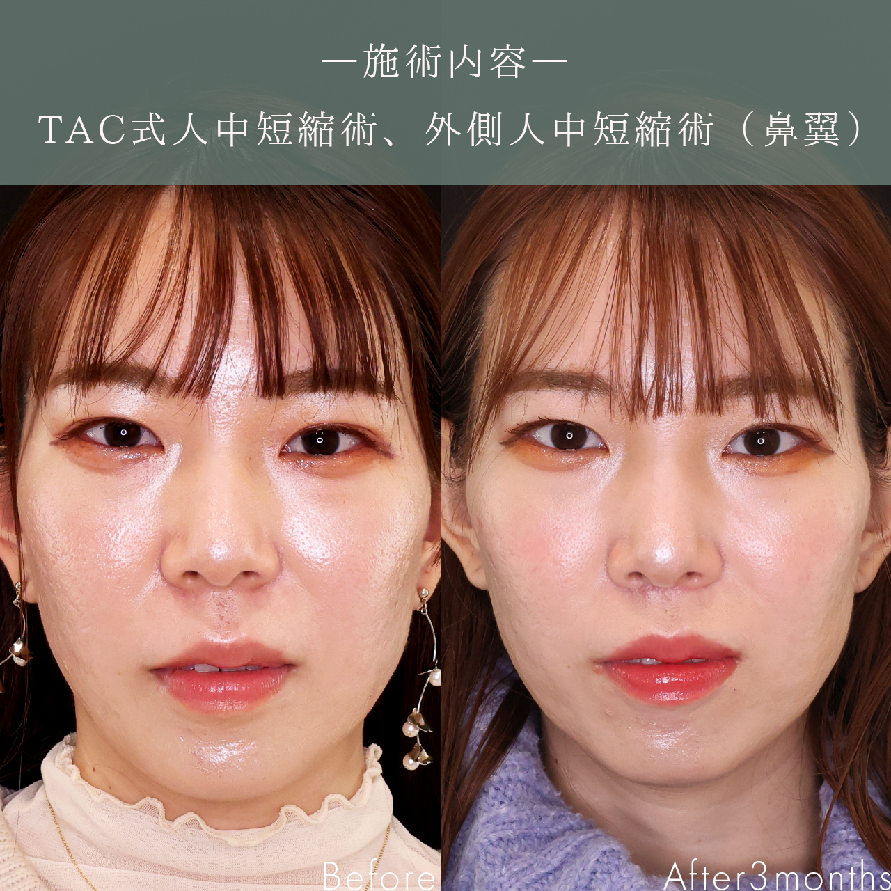 人中短縮術(リップリフト)・外側人中短縮術の症例写真 施術前後 