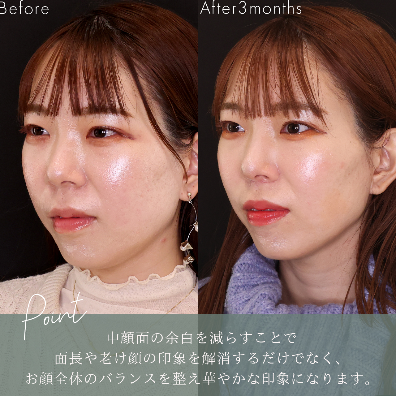 人中短縮術(リップリフト)・外側人中短縮術の症例写真 施術前後 