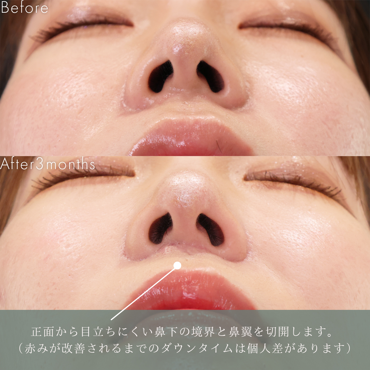 人中短縮術(リップリフト)・外側人中短縮術の症例写真 施術前後 