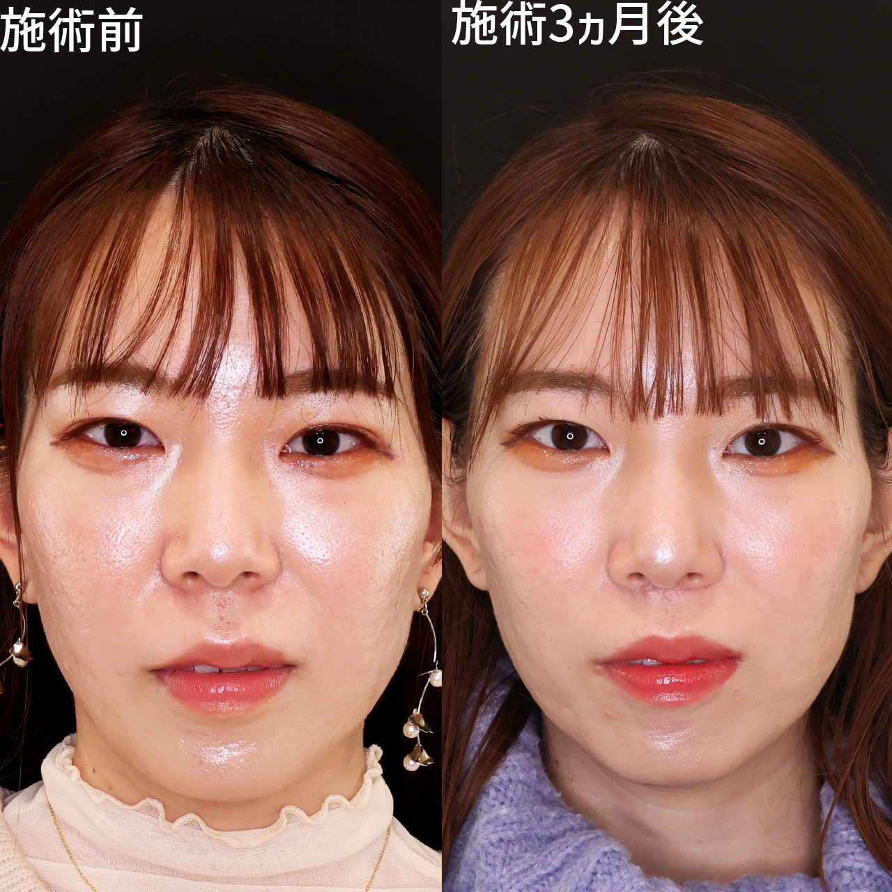 【人中短縮】中顔面のバランスを整えて美しく【Dr.石橋】