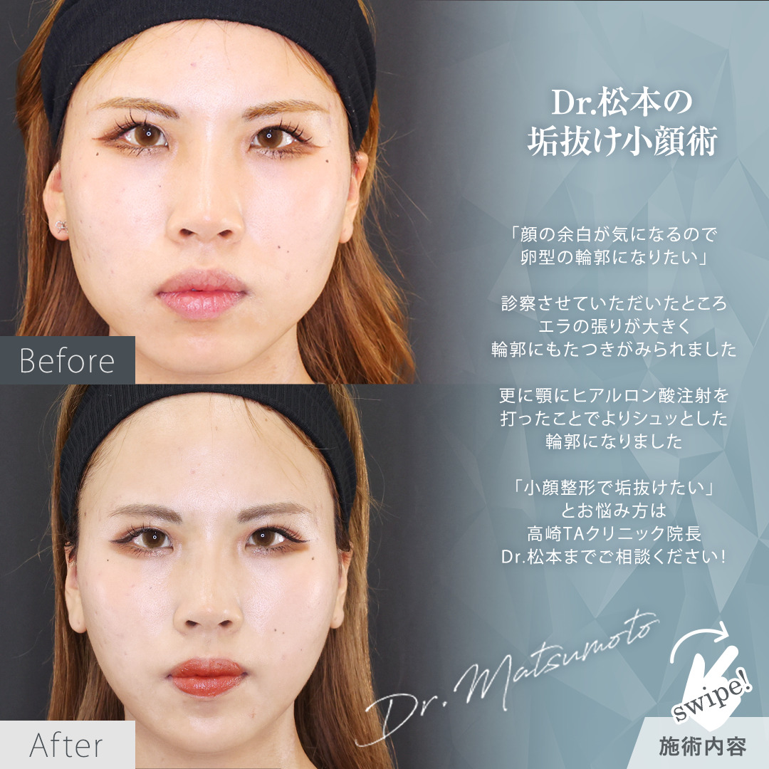 TAC式 ツヤ肌コラーゲンリフト®の症例写真 施術前後 