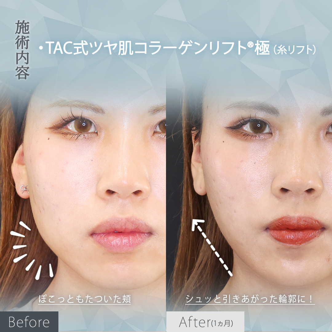 TAC式 ツヤ肌コラーゲンリフト®の症例写真 施術前後 