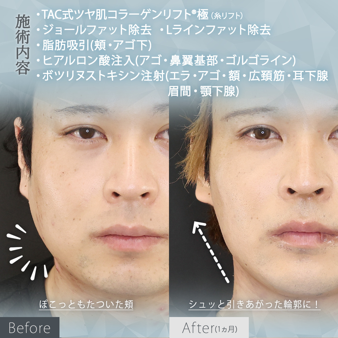 TAC式 ツヤ肌コラーゲンリフト®/ジョールファット除去/Lラインファット除去（エラ下脂肪除去）の症例写真 施術前後 