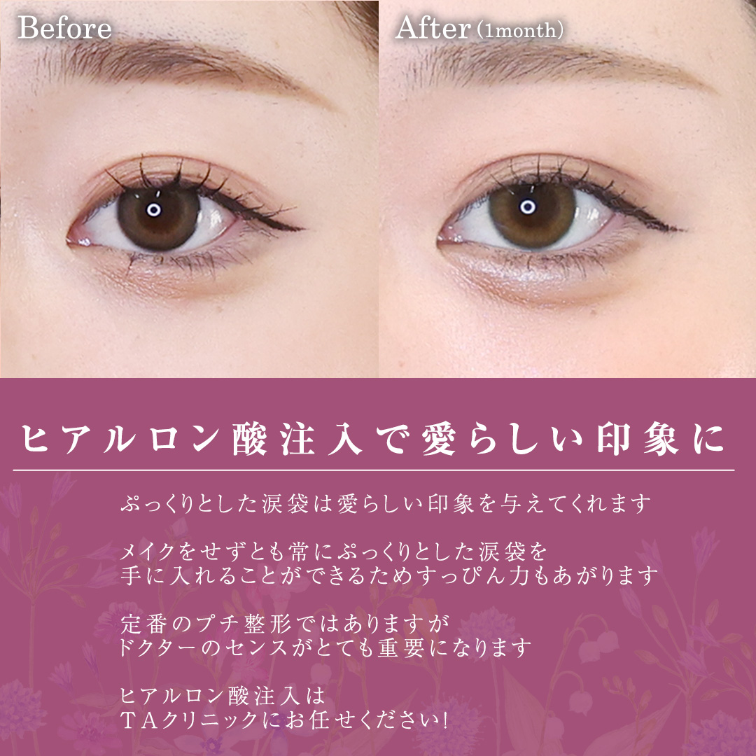 涙袋形成（ヒアルロン酸注射）の症例写真 施術前後 