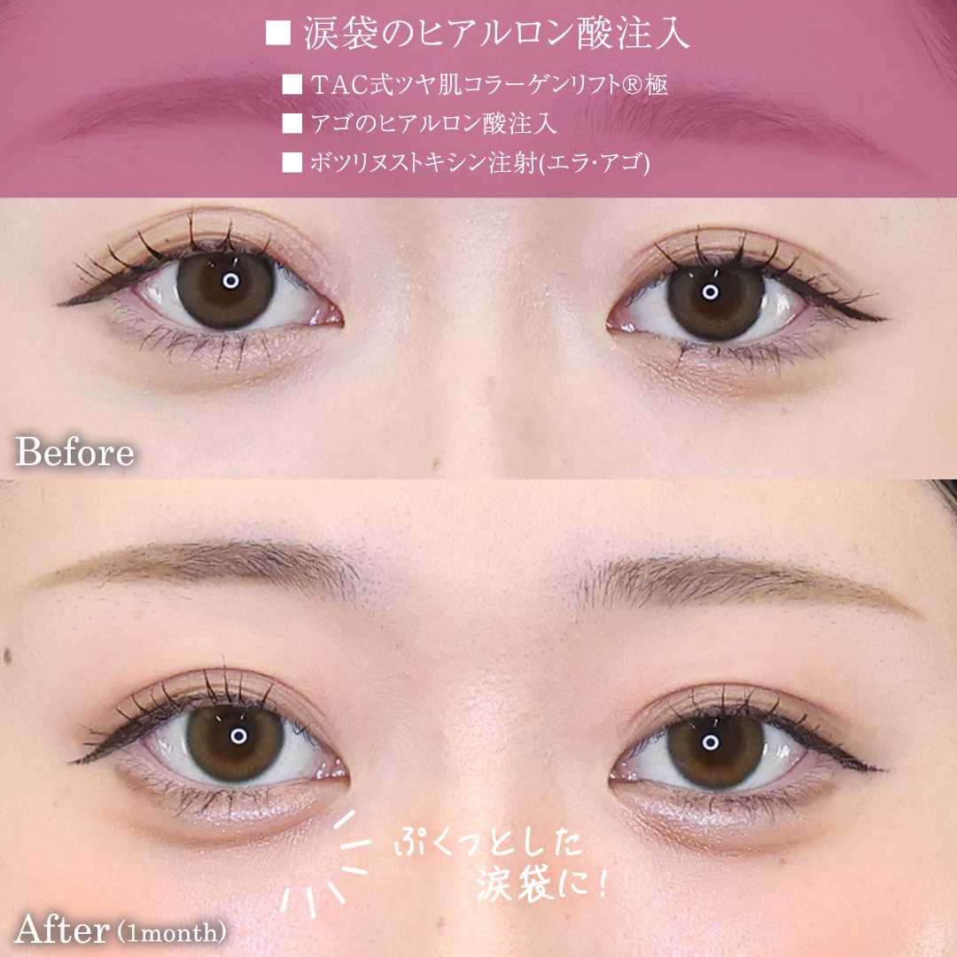涙袋形成（ヒアルロン酸注射）の症例写真 施術前後 