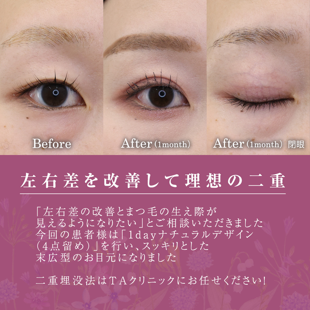 二重埋没法の症例写真 施術前後 