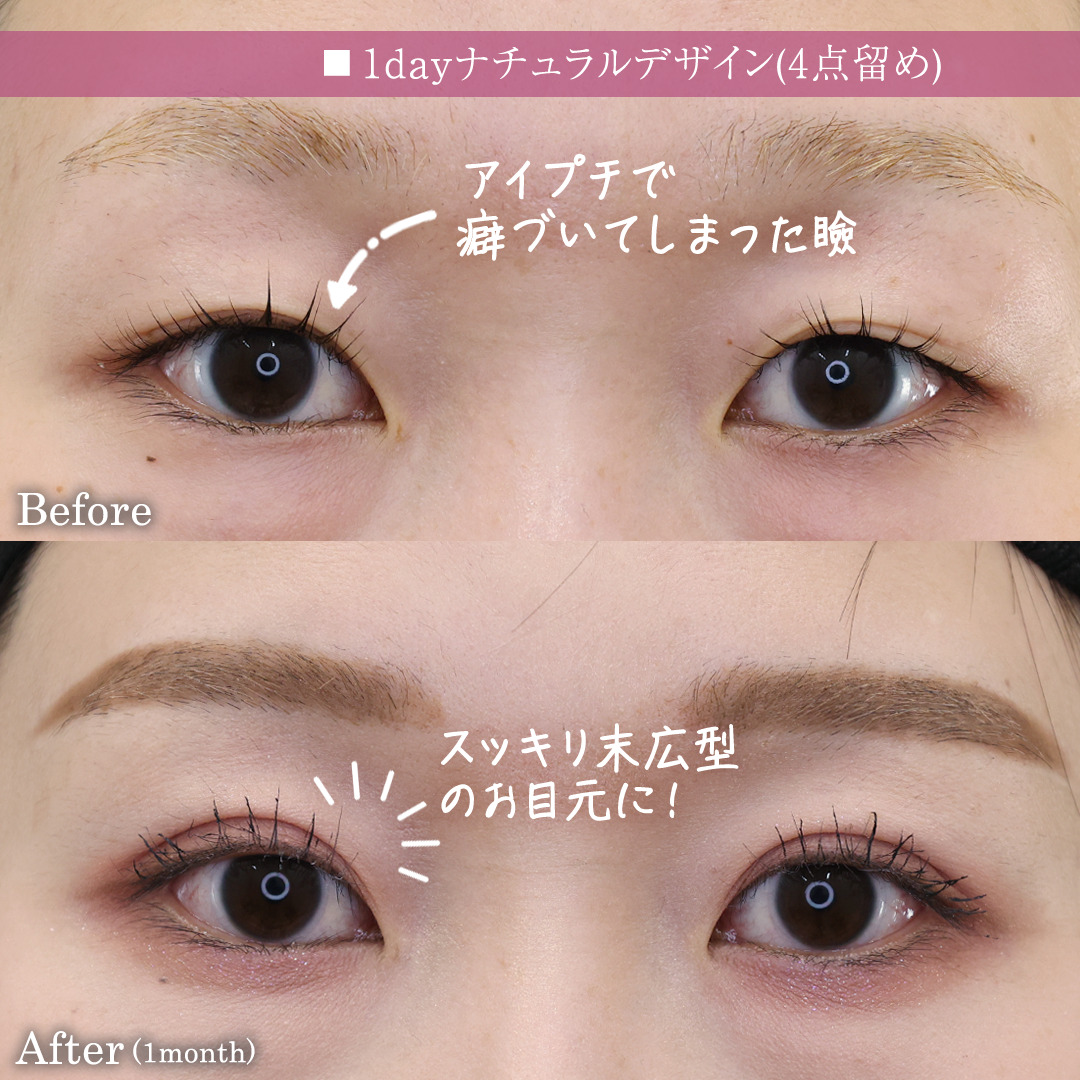 二重埋没法の症例写真 施術前後 