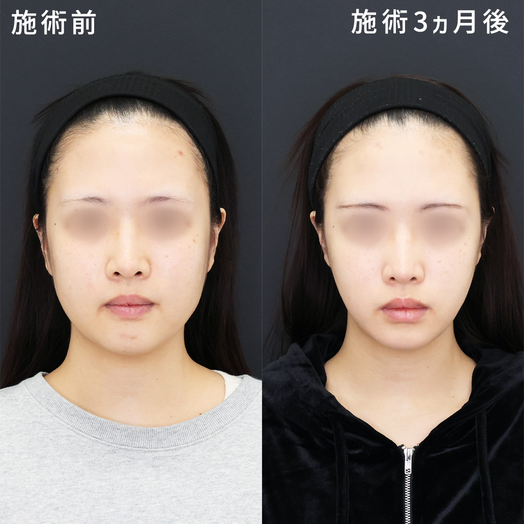 頬の余白感を減らし、もたつきゼロの理想の輪郭に【脂肪吸引×糸リフト】