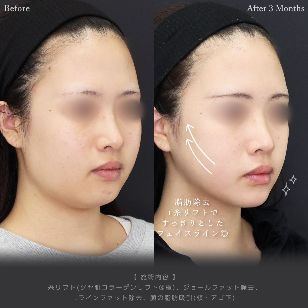 TAC式 ツヤ肌コラーゲンリフト®/ジョールファット除去/Lラインファット除去（エラ下脂肪除去）の症例写真 施術前後 