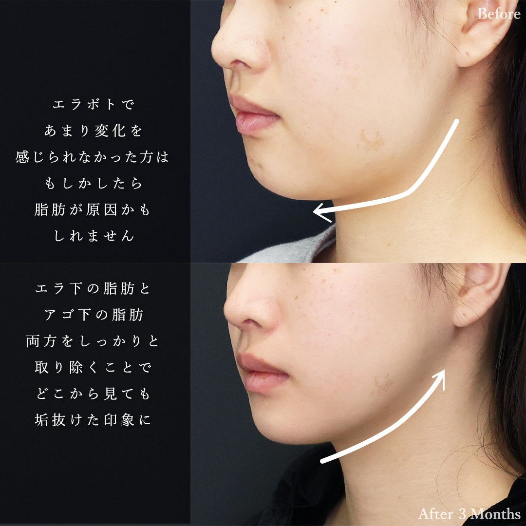 TAC式 ツヤ肌コラーゲンリフト®/ジョールファット除去/Lラインファット除去（エラ下脂肪除去）の症例写真 施術前後 