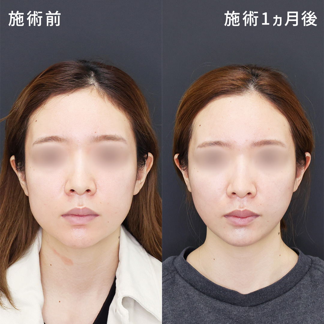 加工アプリ要らずの小顔術【バッカルファット除去×糸リフト】