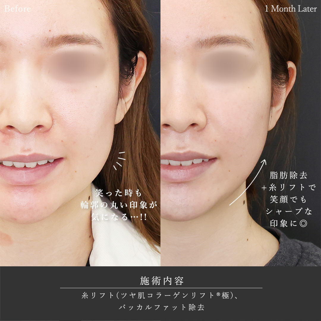 TAC式 ツヤ肌コラーゲンリフト®/バッカルファット除去の症例写真 施術前後 