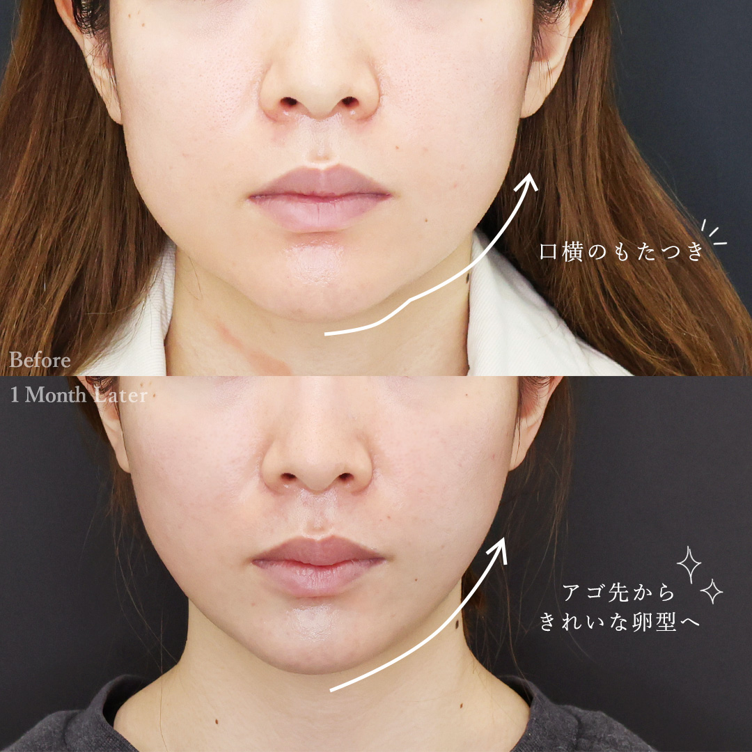TAC式 ツヤ肌コラーゲンリフト®/バッカルファット除去の症例写真 施術前後 