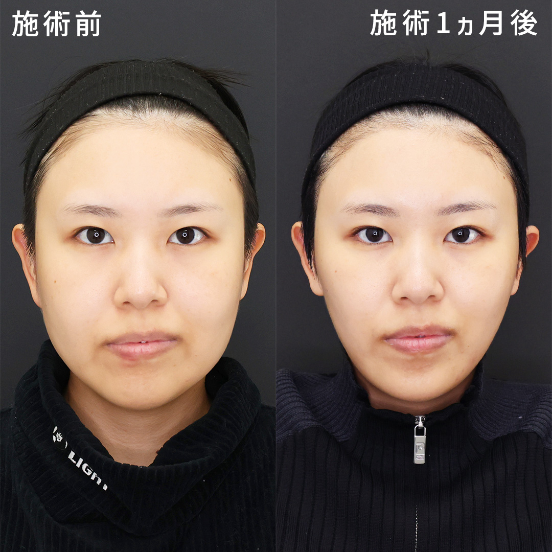 TAC式 ツヤ肌コラーゲンリフト®/ジョールファット除去/顔の脂肪吸引の症例写真 施術前後