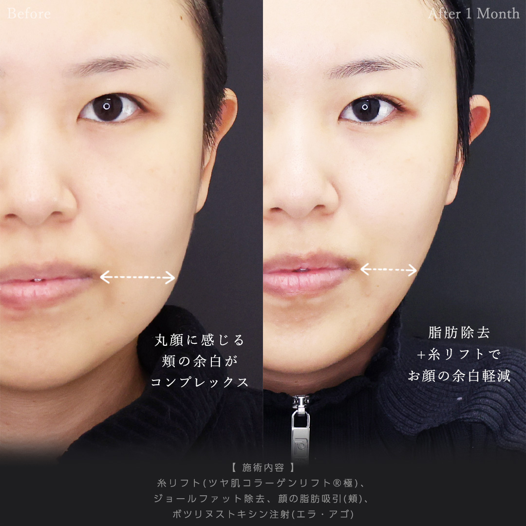 TAC式 ツヤ肌コラーゲンリフト®/ジョールファット除去/顔の脂肪吸引の症例写真 施術前後