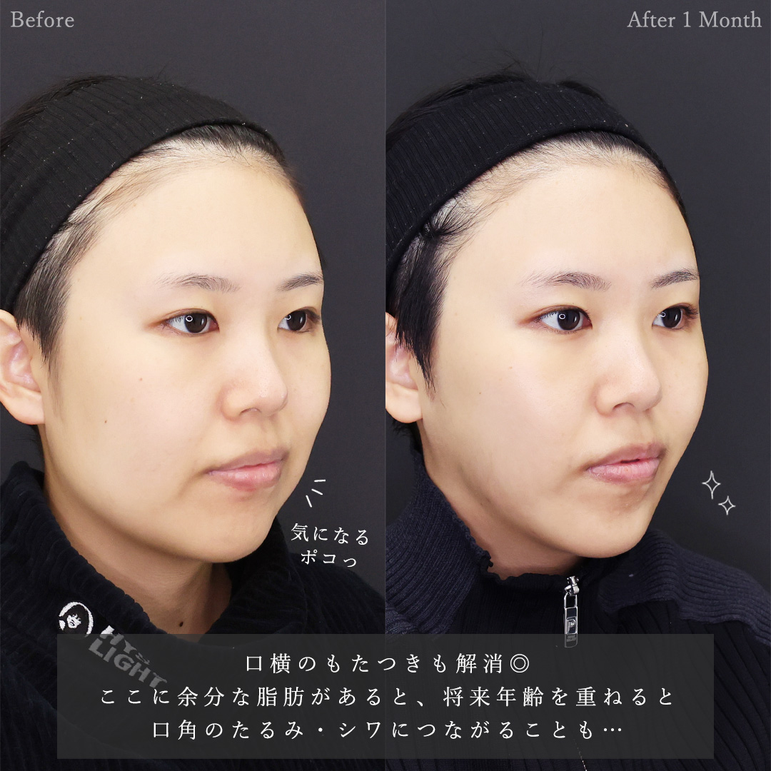 TAC式 ツヤ肌コラーゲンリフト®/ジョールファット除去/顔の脂肪吸引の症例写真 施術前後