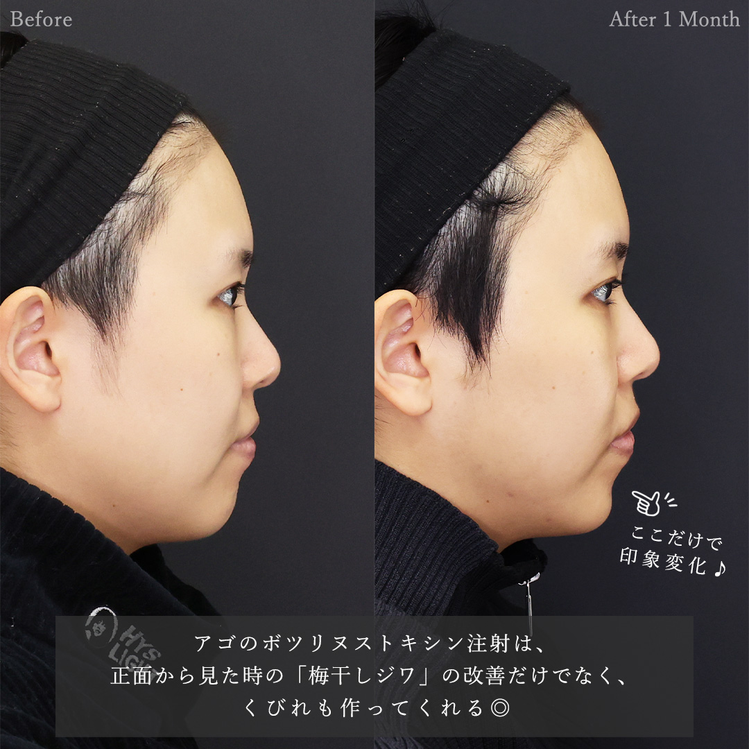TAC式 ツヤ肌コラーゲンリフト®/ジョールファット除去/顔の脂肪吸引の症例写真 施術前後