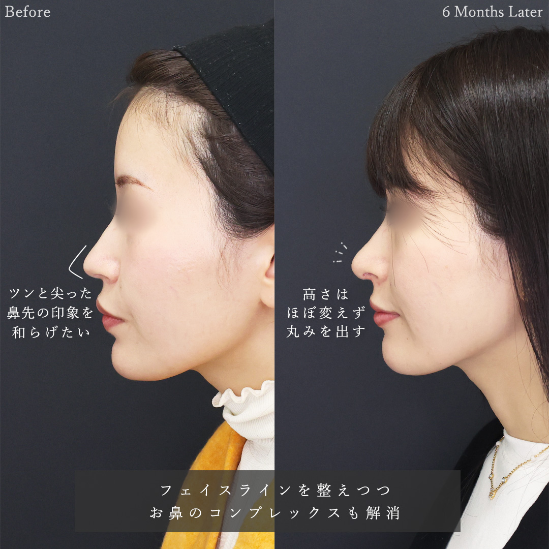 TAC式 ツヤ肌コラーゲンリフト®/顔の脂肪吸引/鼻尖形成・鼻尖縮小の症例写真 施術前後