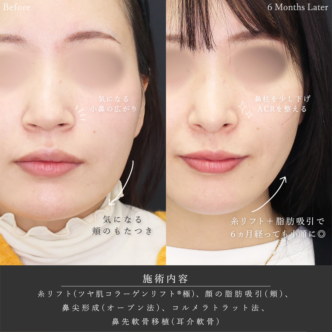 TAC式 ツヤ肌コラーゲンリフト®/顔の脂肪吸引/鼻尖形成・鼻尖縮小の症例写真 施術前後
